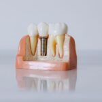 implantes dentales precio