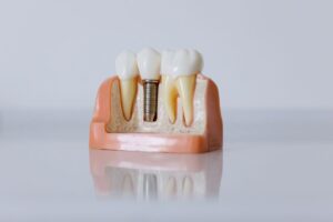 implantes dentales precio